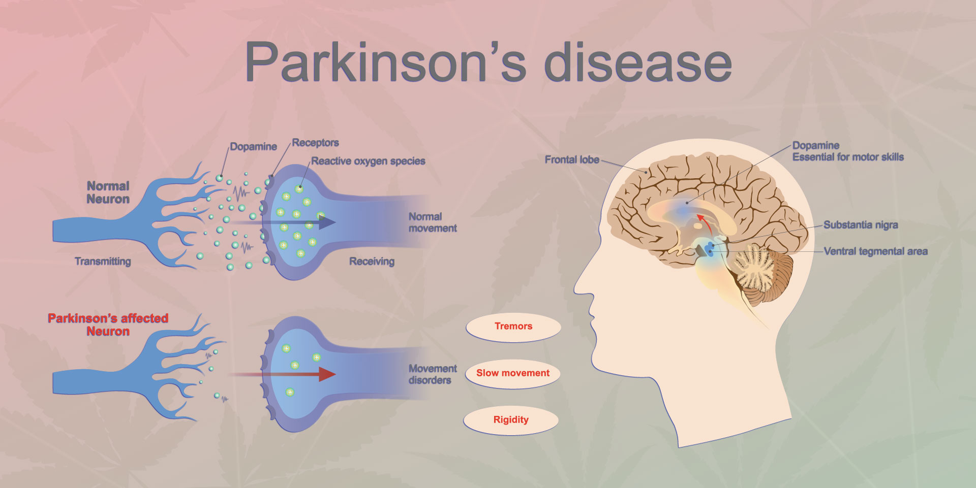 Parkinson's disease is a progressive disorder that is caused by degene...